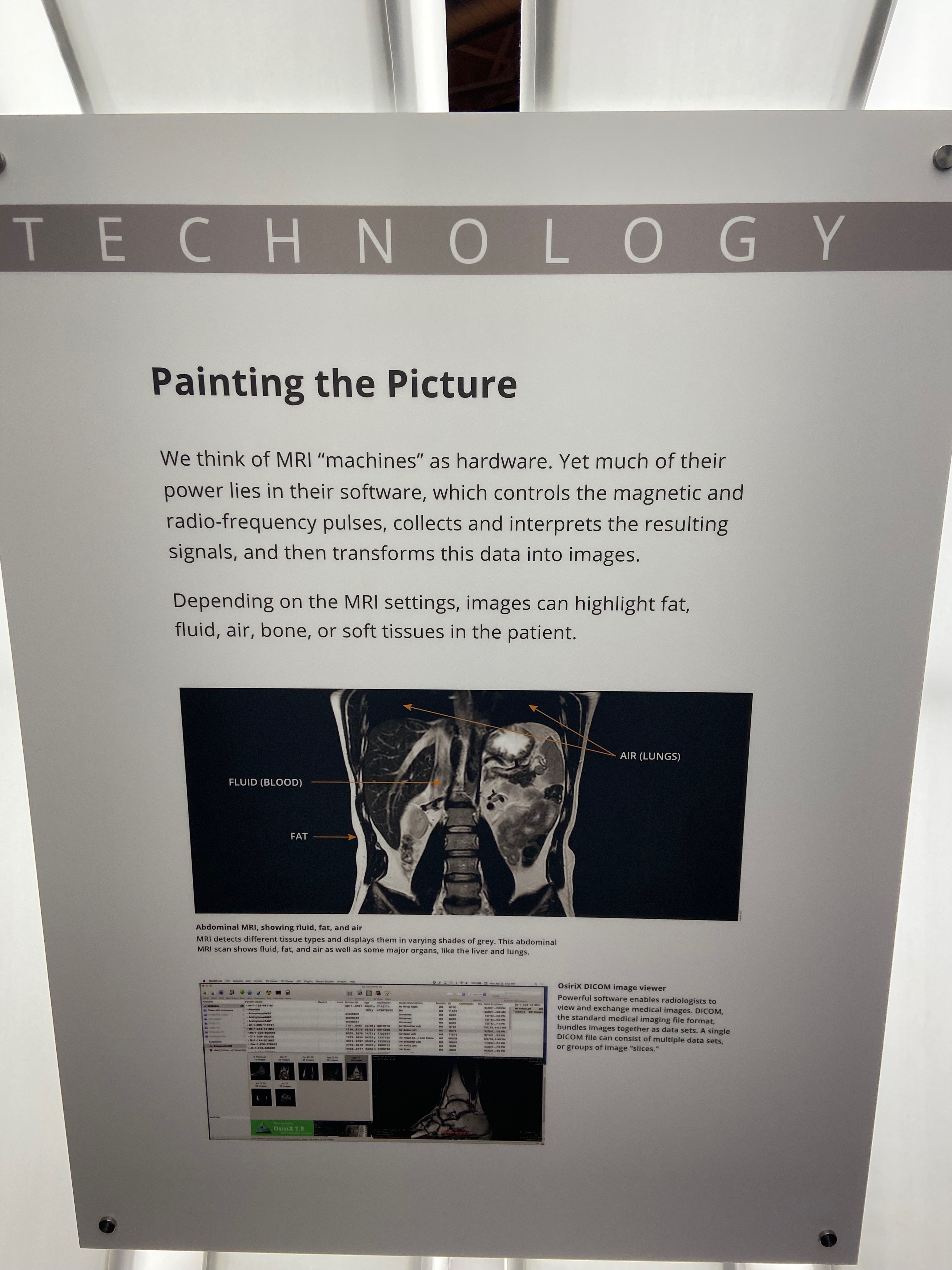 MRI